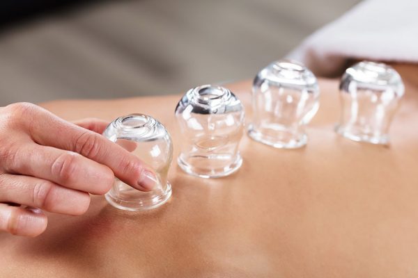 Cupping-therapy