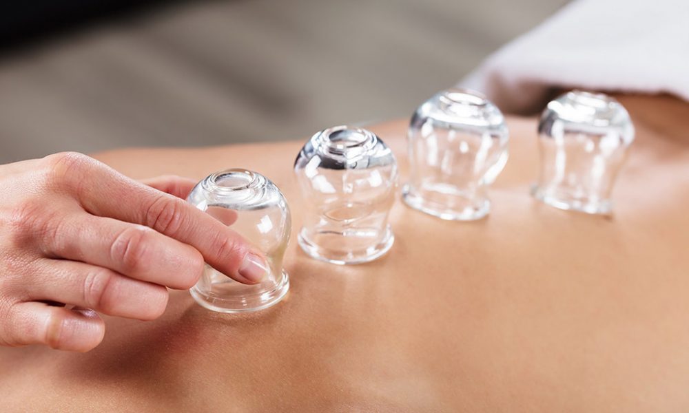 Cupping-therapy
